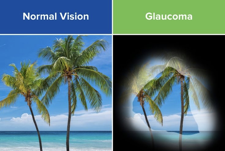 Glaucoma: immagine illustrativa